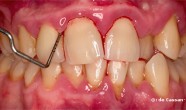 parodontita juvenila