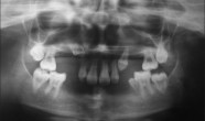 anodontie - lipsa dintilor