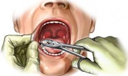 extractia dentara indicatii si contraindicatii