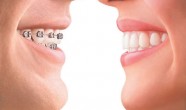 Sfaturi si recomandari aparate ortodontice