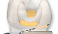 Coafajul indirect in endodontie