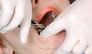 Complicatiile extractiei dentare