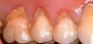 Tartrul dentar (piatra)