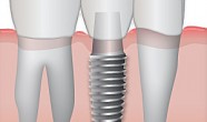 video implant dentar