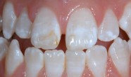 Fluoroza dentara