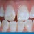 Notiuni generale despre fluoroza dentara