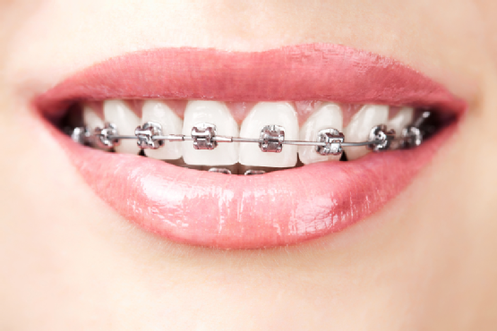 Essentially Laugh portable Aparatul ortodontic la adult: nu este niciodata prea tarziu - Dentistul.info