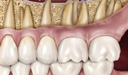 Sinuzita maxilara dentara