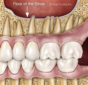 Sinuzita maxilara dentara