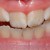 Tratamentul si prevenirea fluorozei dentare