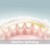 VIDEO. Imobilizare cu Dentapreg pentru dinti afectati parodontali