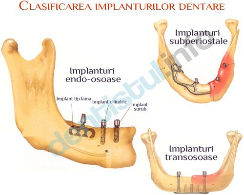 Clasificare-implanturi-dentare_min